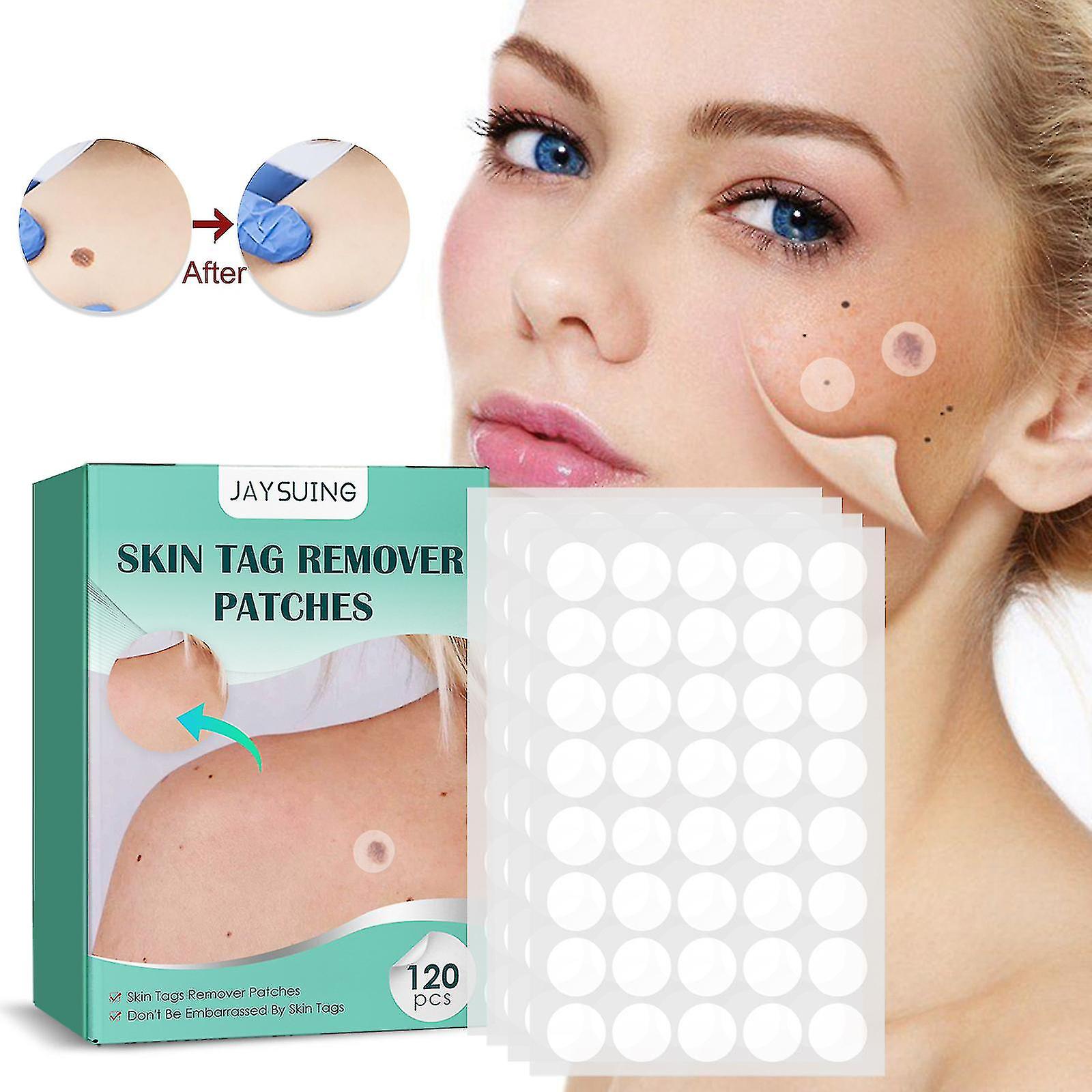 Mole Removal Patches